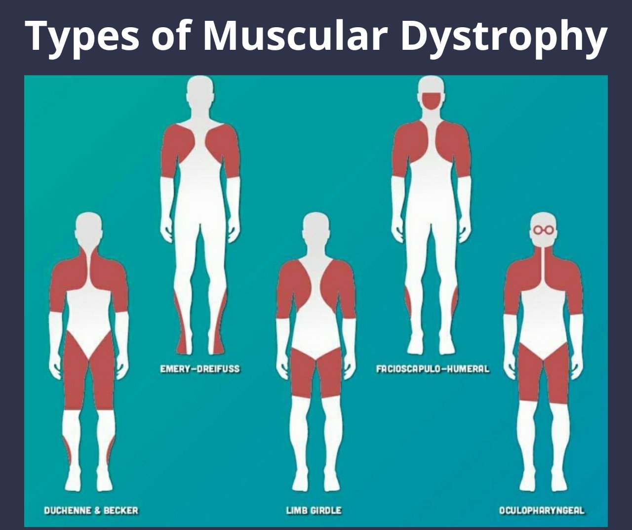 Types of Muscular Dystrophy